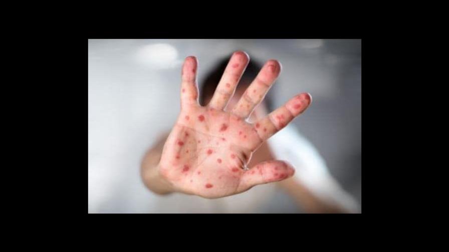 Viruela del mono: qué hacer si hay síntomas