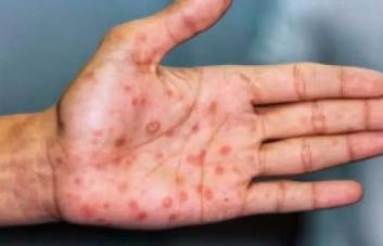 El 40 % de pacientes con viruela del mono sufren complicaciones, según estudio