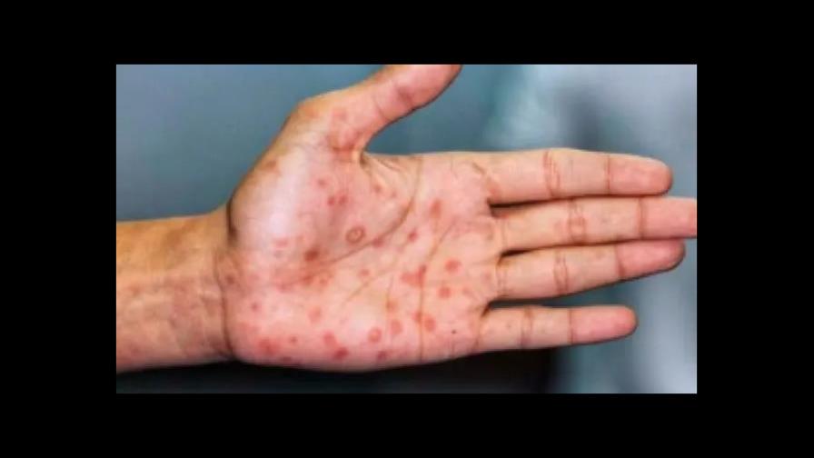 Guatemala suma tres casos confirmados de viruela del mono