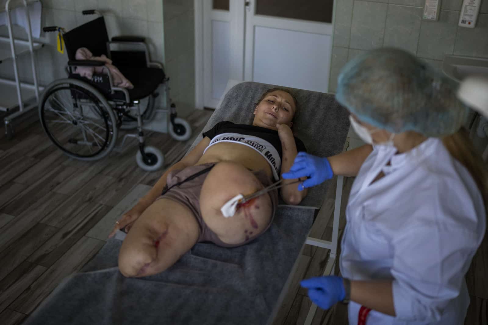 Archivo - Oksana Balandina, de 23 años, recibe tratamiento de una doctora que le limpia sus heridas en un hospital público en Leópolis, Ucrania, el 14 de mayo de 2022.