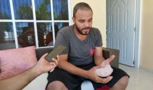 Hombre casi pierde un dedo por picadura de una ara&ntilde;a en Valverde