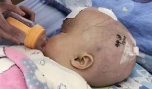 Fundación Cruz Jiminián anuncia jornada quirúrgica gratis a niños con hidrocefalia