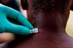Expertos de UA: Viruela del mono se expande en África por la falta de vacunas