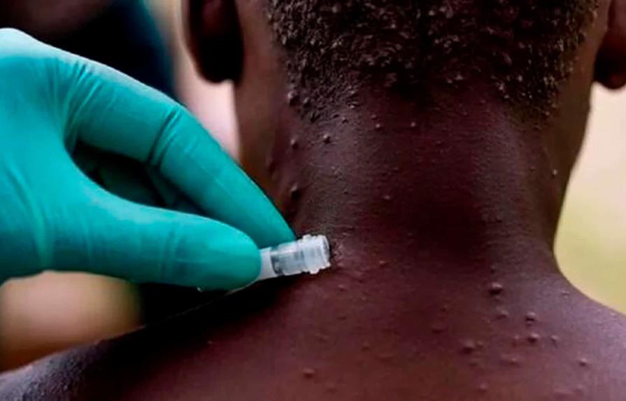 Expertos de UA: Viruela del mono se expande en África por la falta de vacunas