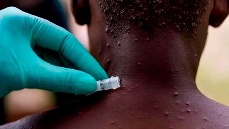 Expertos de UA: Viruela del mono se expande en África por la falta de vacunas Expertos de UA: Viruela del mono se expande en África por la falta de vacunas