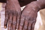 Un paciente haitiano en Ocoa es el décimo caso de viruela símica en RD