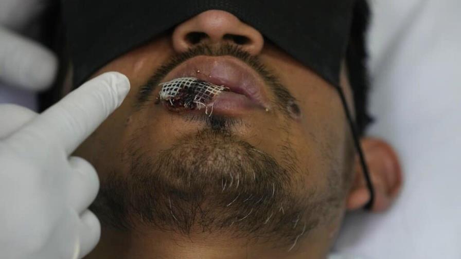 Países de las Américas son el epicentro del brote de viruela símica según OPS Países de las Américas son el epicentro del brote de viruela símica según OPS