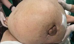 Extirpan tumor de casi 100 libras a una mujer que lo soport&oacute; por cinco a&ntilde;os