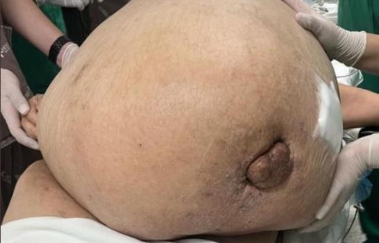 Extirpan tumor de casi 100 libras a una mujer que lo soportó por cinco años