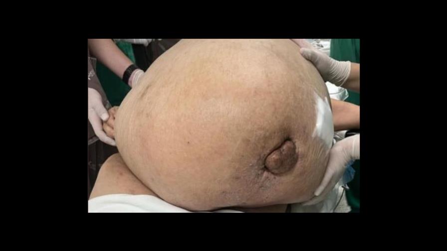 Extirpan tumor de casi 100 libras a una mujer que lo soportó por cinco años