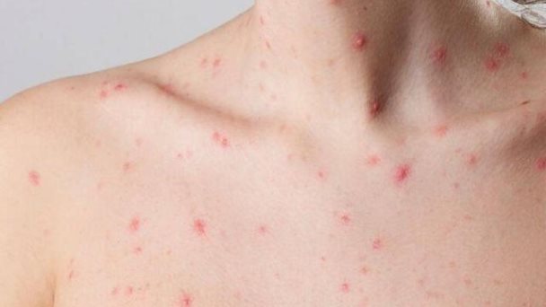 EEUU: Viruela símica podría mutar para resistir a fármaco