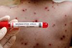 Ministerio de Salud Pública notifica tres nuevos casos de viruela símica en el país Ministerio de Salud Pública notifica tres nuevos casos de viruela símica en el país