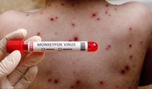 Ministerio de Salud Pública notifica tres nuevos casos de viruela símica en el país