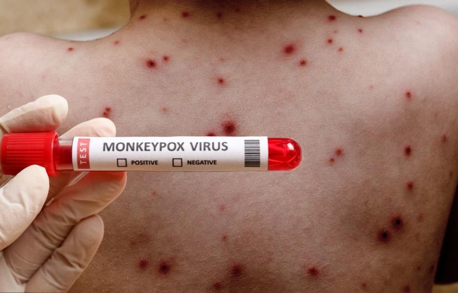 Ministerio de Salud Pública notifica tres nuevos casos de viruela símica en el país