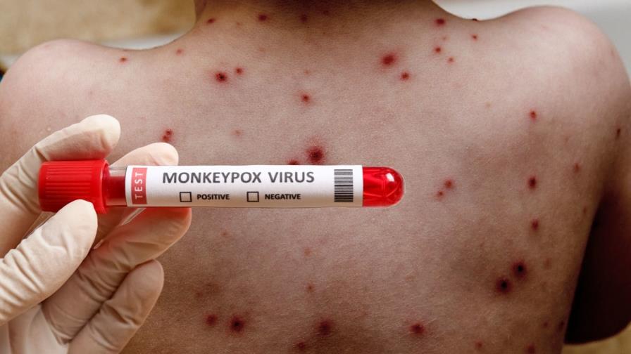 Ministerio de Salud Pública notifica tres nuevos casos de viruela símica en el país