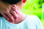 Es posible controlar la dermatitis atópica en niños y adolescentes Es posible controlar la dermatitis atópica en niños y adolescentes