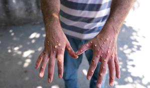 México supera los 1,000 casos confirmados de viruela del mono