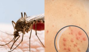 Casos de dengue ascienden a 5,660 y los de viruela símica a 25