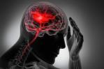 Hallan 89 genes implicados en el riesgo de sufrir un accidente cerebrovascular Hallan 89 genes implicados en el riesgo de sufrir un accidente cerebrovascular