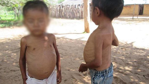 ONG alerta de que 1.4 millones de niños sufren desnutrición en Sudán del Sur