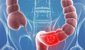 Las causas del aumento del c&aacute;ncer colorrectal en menores de 50 a&ntilde;os siguen sin conocerse