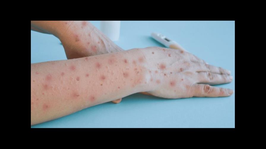 Salud Pública notifica dos nuevos casos de viruela símica