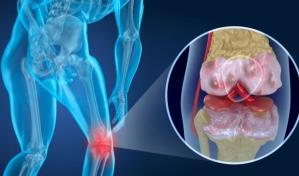Artrosis de rodilla puede afectar a 6 de cada 10 personas para 2030 en México