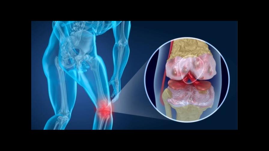 Artrosis de rodilla puede afectar a 6 de cada 10 personas para 2030 en México Artrosis de rodilla puede afectar a 6 de cada 10 personas para 2030 en México