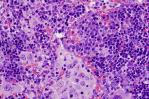 Revelan una mutación genética clave asociada a linfomas y cáncer de pulmón Revelan una mutación genética clave asociada a linfomas y cáncer de pulmón