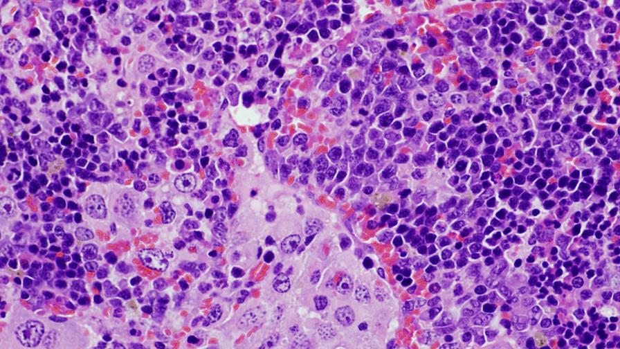 Revelan una mutación genética clave asociada a linfomas y cáncer de pulmón