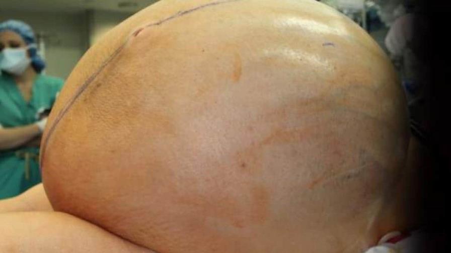 Extirpan un cáncer de ovario de 70 kilos a una mujer italiana en Turín