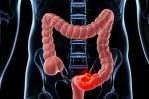 Identifican las células responsables de la recaída en el cáncer de colon Identifican las células responsables de la recaída en el cáncer de colon