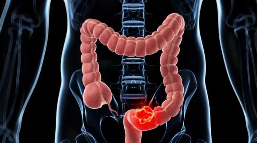 Identifican las células responsables de la recaída en el cáncer de colon