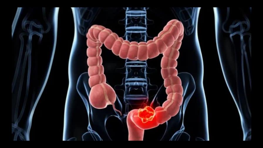 Identifican las células responsables de la recaída en el cáncer de colon