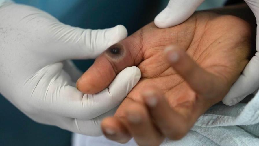 Confirman la primera muerte por viruela del mono en Chile