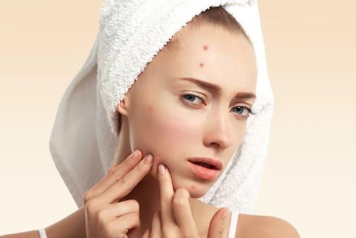 Qué hacer cuando el acné se transforma en una herida