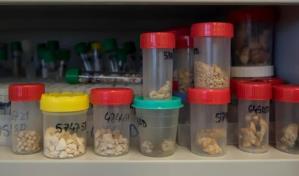 Universidad española cuenta con el primer biobanco de piedras de riñón del mundo