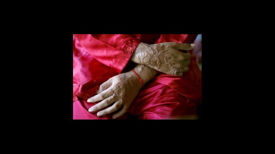 Indignación por el ataque con ácido a una joven de 17 años en Nueva Delhi