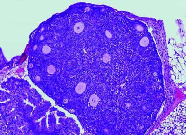 La mutación de un único gen está detrás de un tipo de cáncer de ovario