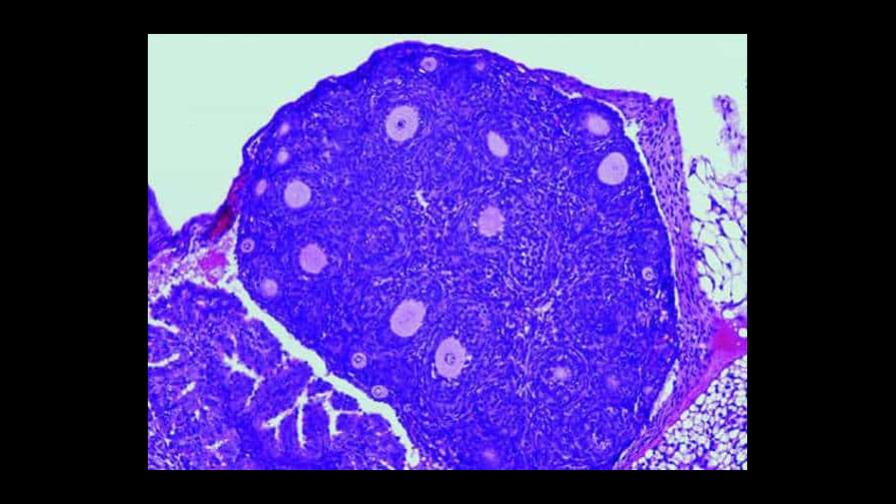 La mutación de un único gen está detrás de un tipo de cáncer de ovario