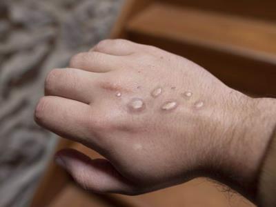 OMS declara el mpox como una emergencia internacional