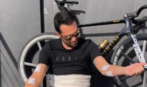 Extirpan a Alberto Contador más de cien tumores benignos