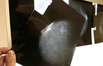 Desarrollan predictor de riesgo de progresión de células de precáncer de mama