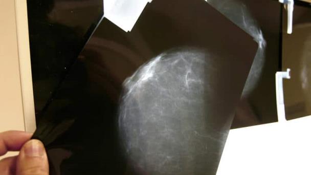 Desarrollan predictor de riesgo de progresión de células de precáncer de mama