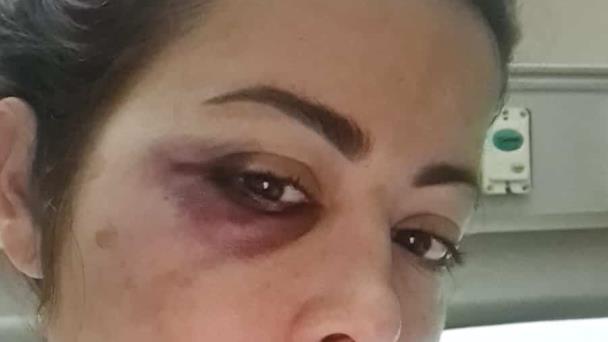 Dafne Guzmán es sometida a operación luego de caerse de su cama