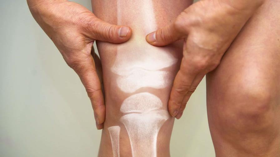Científicos de Florida descubren nueva forma de tratar la osteoporosis