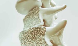 Cient&iacute;ficos de Florida descubren nueva forma de tratar la osteoporosis