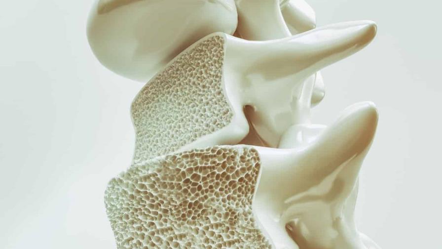 Científicos de Florida descubren nueva forma de tratar la osteoporosis Científicos de Florida descubren nueva forma de tratar la osteoporosis