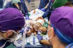 Separan con éxito a gemelas que compartían el mismo hígado Separan con éxito a gemelas que compartían el mismo hígado