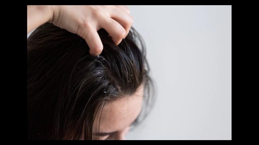 Causas por las que se produce la caspa